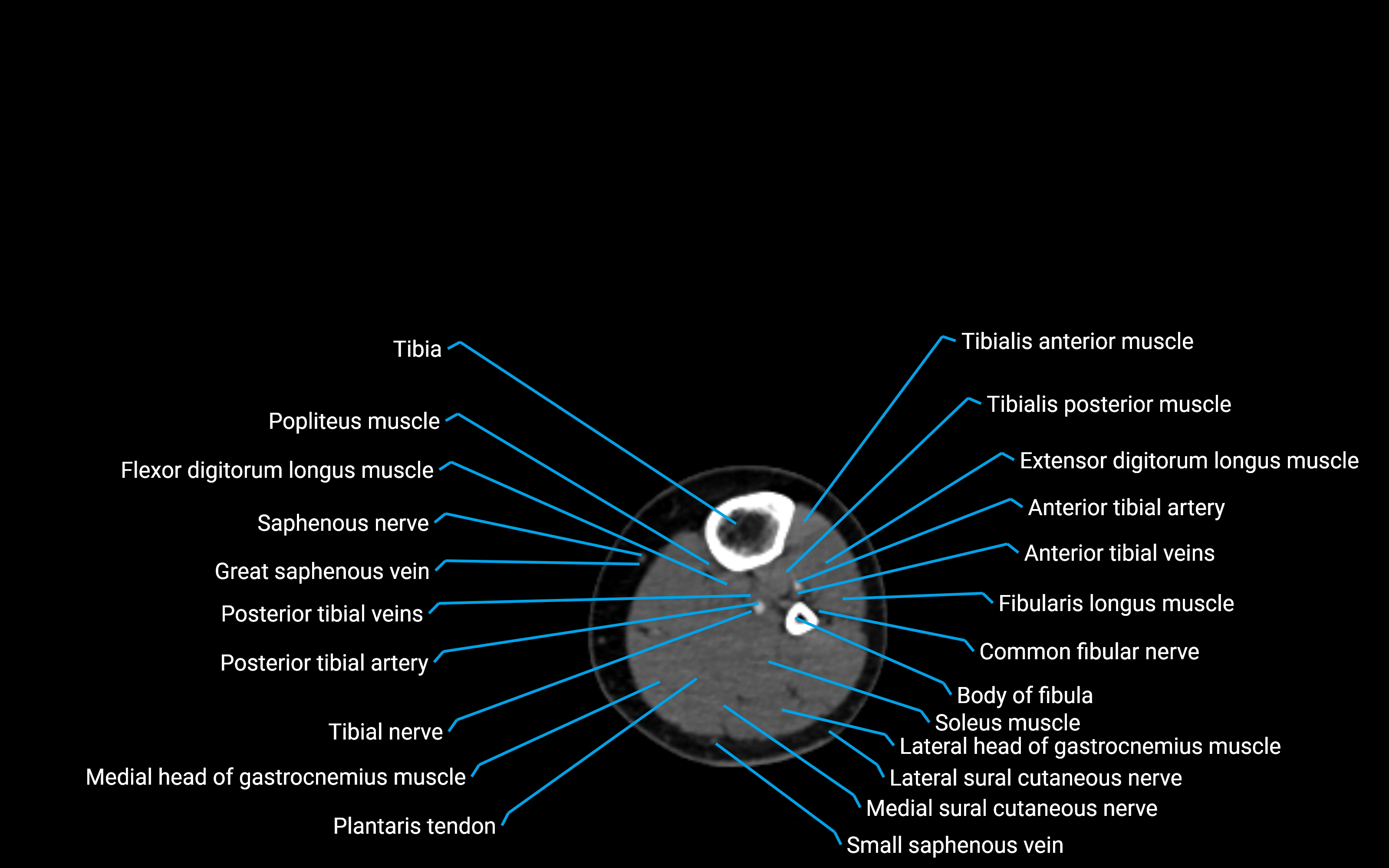 CT Lower leg axial cross sectional anatomy labelled image 104 (2).png